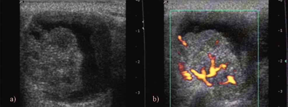 242 Daniela Fodor et al Gray scale and Doppler ultrasonography of the benign tumors of parotid gland Fig 8.