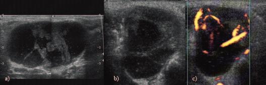 Large Warthin s tumor with mixt structure: a) longitudinal scan; b) transverse scan; c) power Doppler US.