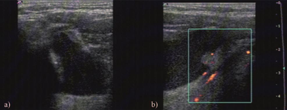 244 Daniela Fodor et al Gray scale and Doppler ultrasonography of the benign tumors of parotid gland Fig 14.