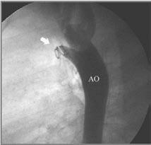 Figure 11a: Picture in aorta (Ao) as seen from the side shows an open PDA (arrow), with blood flowing from the aorta to the pulmonary artery (PA).