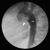 For the most part, coils are used. Figure 11b: A coil is implanted in the PDA (arrow). Figure 12a: (Courtesy of AGA Medical Corporation) This graph illustrates a PDA being closed by a device occluder.