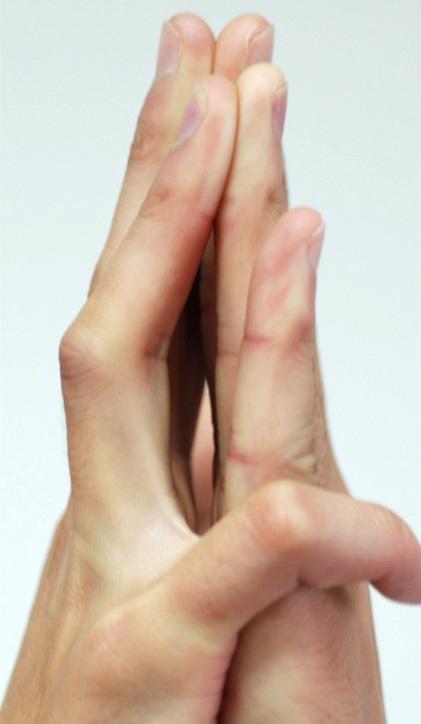 140 anatomically, the FDP tendon of the little finger has a connection with the FDS or FDP tendons of the ring finger; and 3) the FDP tendon of the little