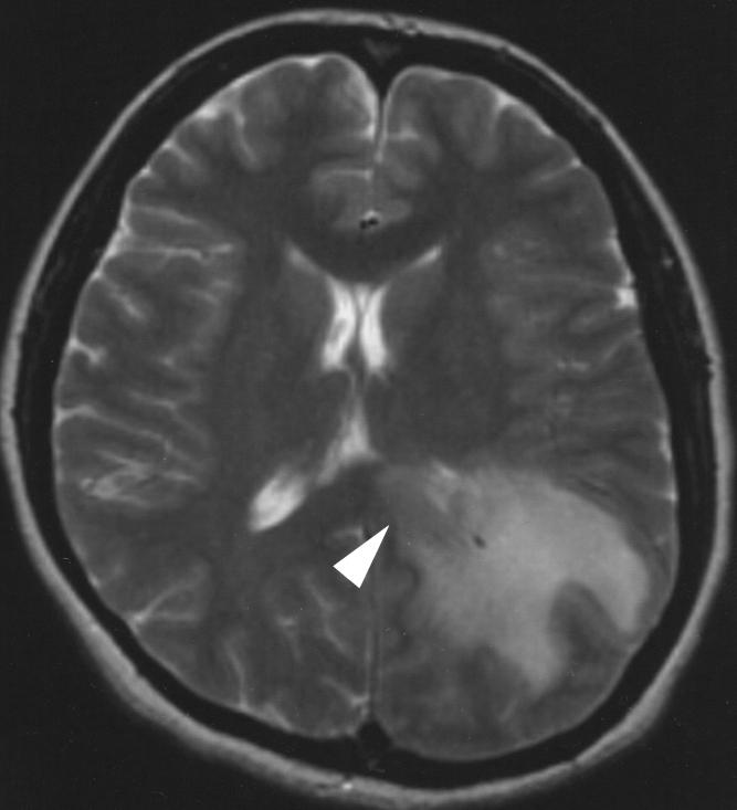 [6] reported the mean relative cerebral blood volume (rv) within tumefactive demyelinating lesions was lower than that within the contralateral normal-appearing white matter and substantially less