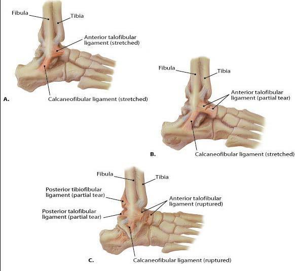 ANKLE SPRAIN What is the ATFL? The ankle joint is made up of the tibia, fibula (bones in the lower leg) and the talus (bone below the tibia and fibula).