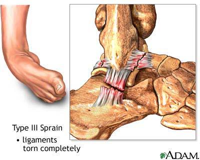 tear of the ligaments. When this occurs there is immediate pain, swelling and difficulty walking.