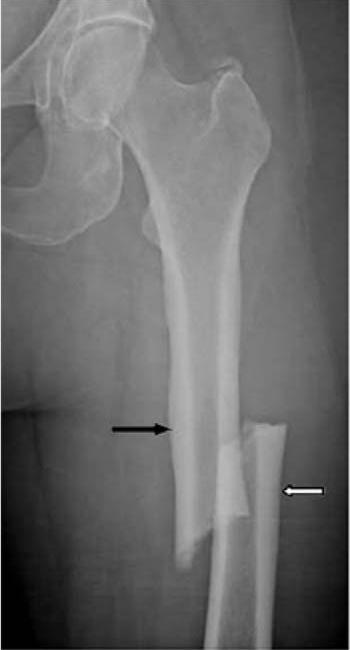Atypical Transverse Femoral midshaft fracture diffuse