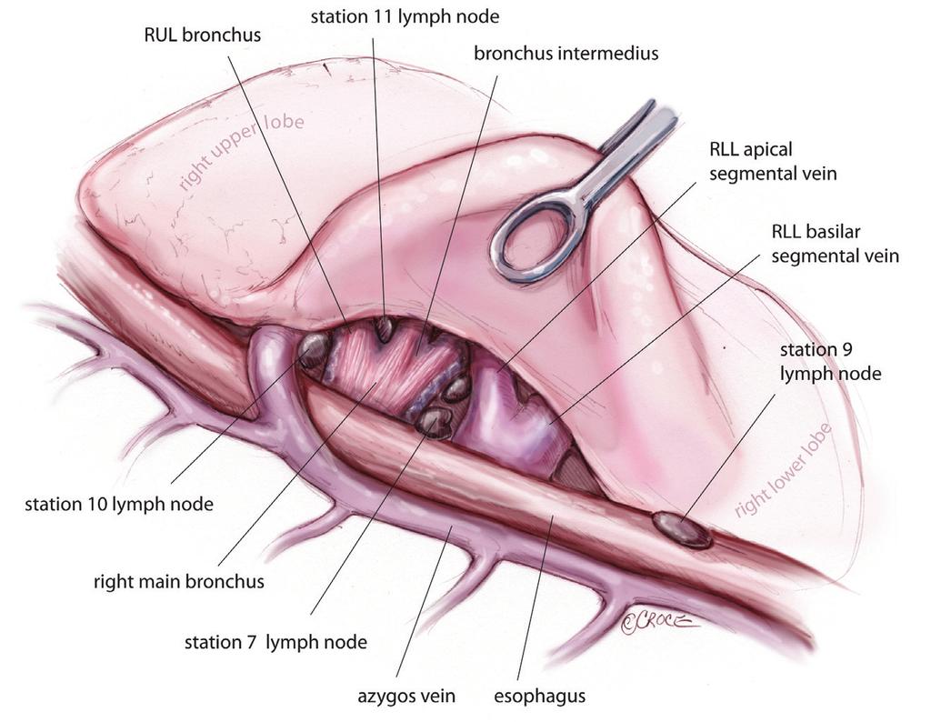 Annals of cardiothoracic surgery, Vol 3, No 2 March 2014 187 Figure 5 Viewed from the posterior hilum, the landmark station 11 lymph node is exposed by clearing the lung tissue away from the bronchus