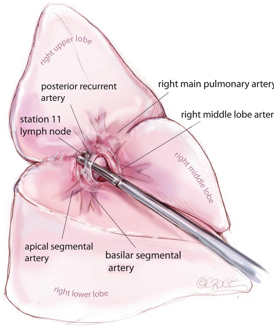 Right upper lobectomy Figure 6 From the anterior port site, dissection forceps are passed gently immediately superficial and posterior to this station 11 landmark lymph node, where it has been