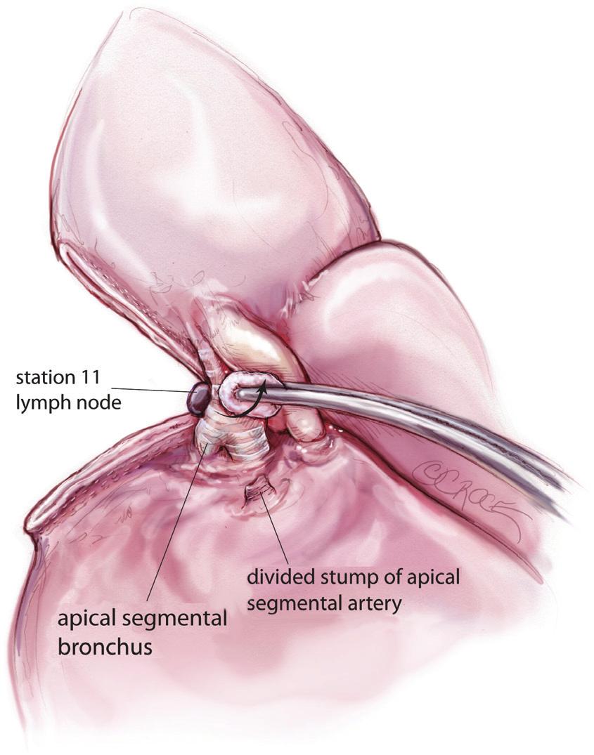 190 Yan. Thoracoscopic lobectomy and segmentectomy Figure 11 The apical segmental vein is divided using an endoscopic linear stapling device.
