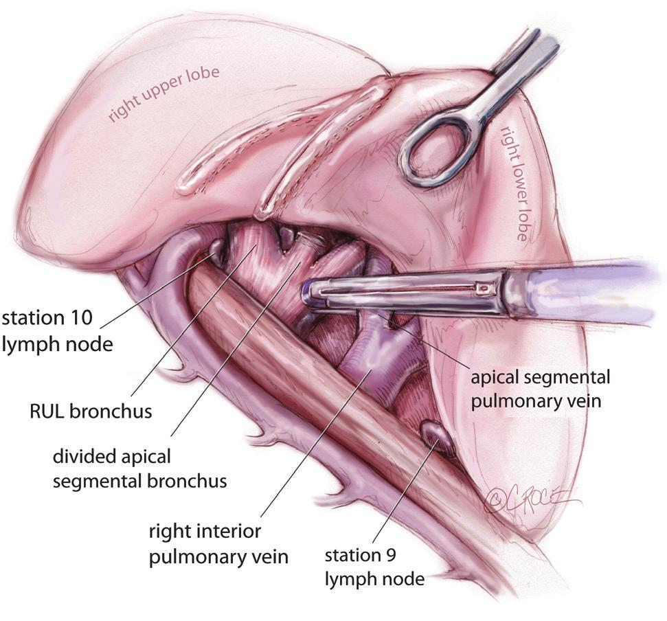 (Figure 10). The apical segmental bronchus is divided with a stapler, passed through the anterior access port. Lymph nodes are the cleared from the medial and lateral margins of the bronchus.