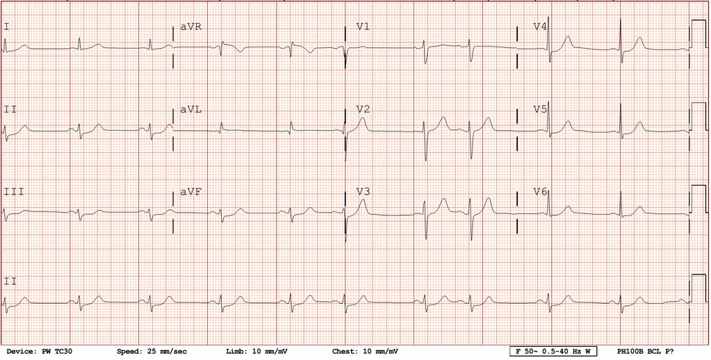 ECG # 4: A 74-year-old woman with