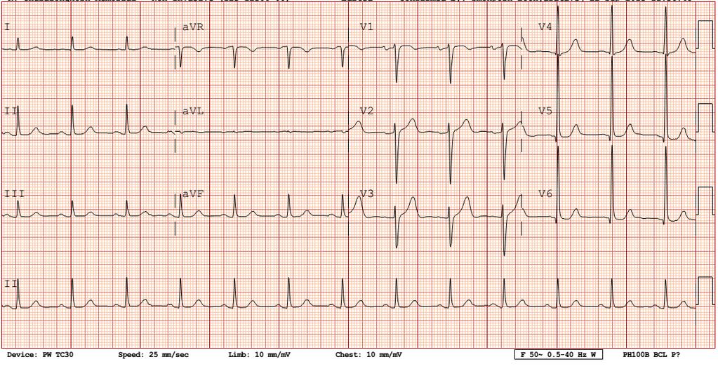 ECG # 9: A 73-year-old man with