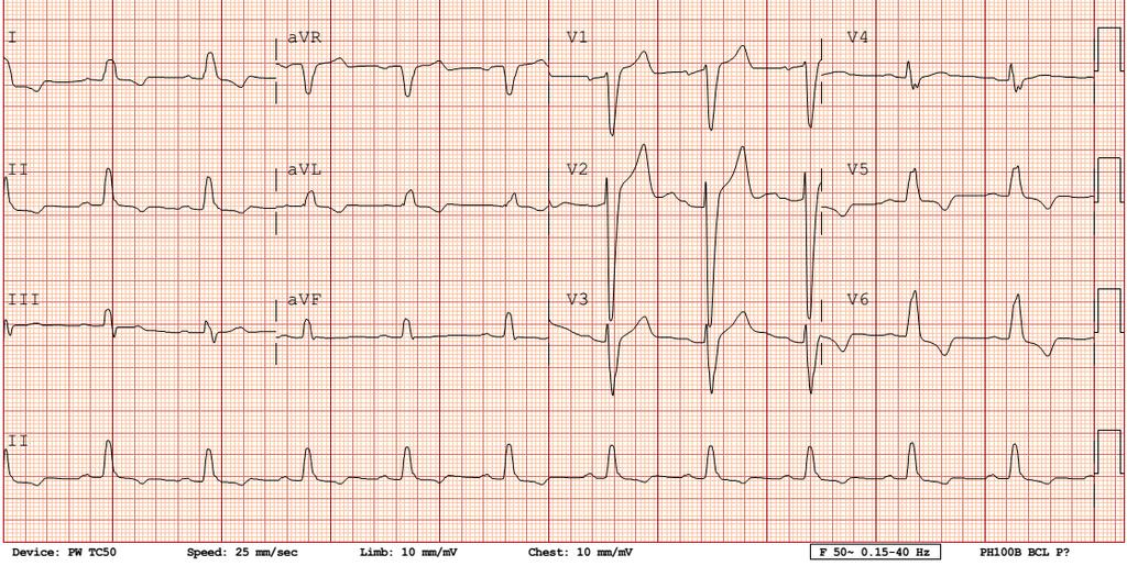 ECG # 11: A 79-year-old woman with