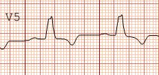 ECG # 11: A 79-year-old woman with history of progressive dyspnea Selected Findings Normal rate Normal axis LAE LBBB complete Description This ECG shows ventricular rate of 65-70 bpm.