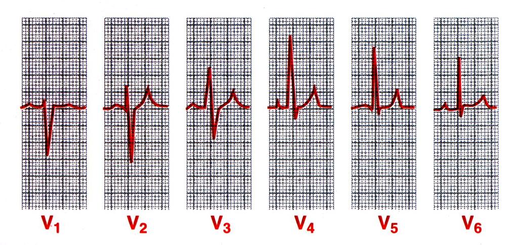 Other EKG Leads Chest Leads (Precordial Leads) known as V 1 -V 6 are