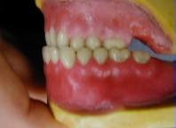 2. Mesio-buccal cusp of maxillary 1 st molar fit in to the
