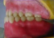 Set the mandibular 2 nd molar,the mesio-buccal cusp of