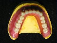 The last tooth are mandibular 1 st premolar which should be