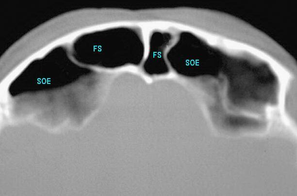 Axial CT showing