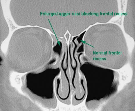 Coronal CT showing enlarged agger nasi blocking