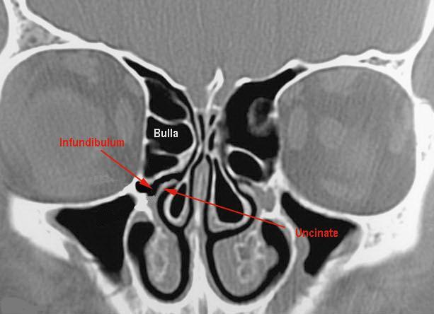 Frontal sinus drains directly into middle meatus as shown in this figure This coronal CT scan shows the