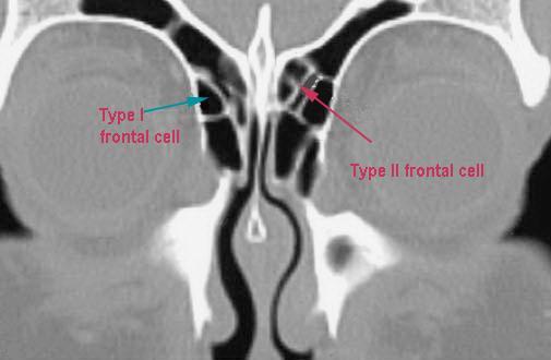 Anatomic variants of frontal sinuses: Detailed understanding of variations seen in the anatomy of frontal sinus will help the surgeon to avoid unnecessary complications during surgical procedures