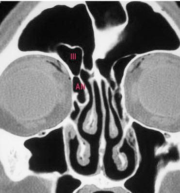 Coronal CT showing Type III frontal cell Coronal CT showing type IV frontal cell Supraorbital