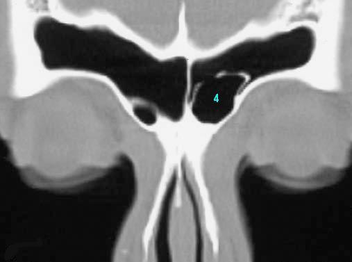 posterior to the frontal recess and lateral to the frontal sinus.
