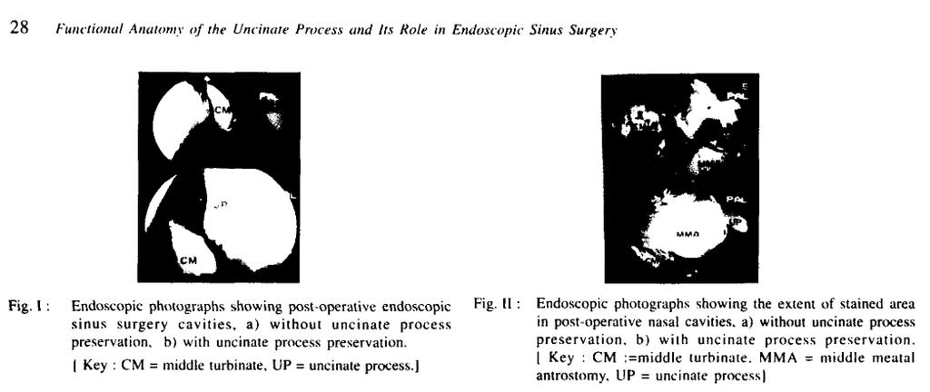 sinus surgery as described by Messerklinger, wherein infundibulotomy forms an integral step by removal of the uncinate process [Stammberger and Posawetz, 1990; Kennedy et al, 1985; Rice, 1989].