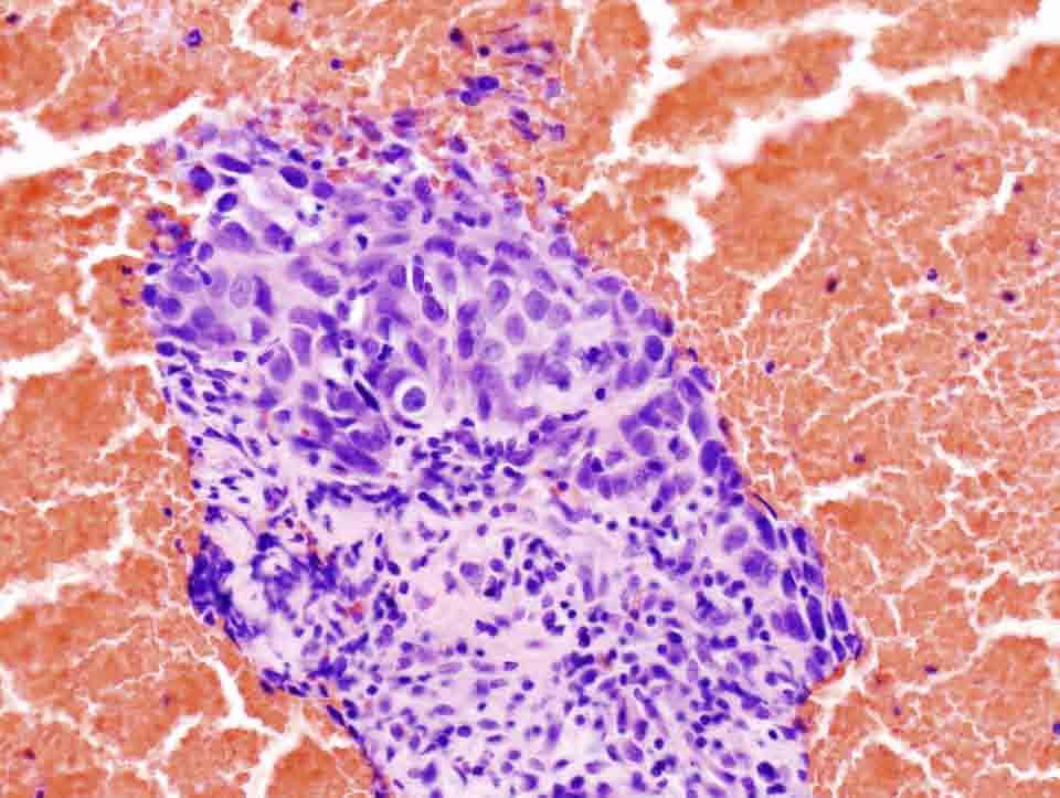 Lung, left middle lobe, CT-guided FNA: Cell Block, H & E stain, 20x Presentation