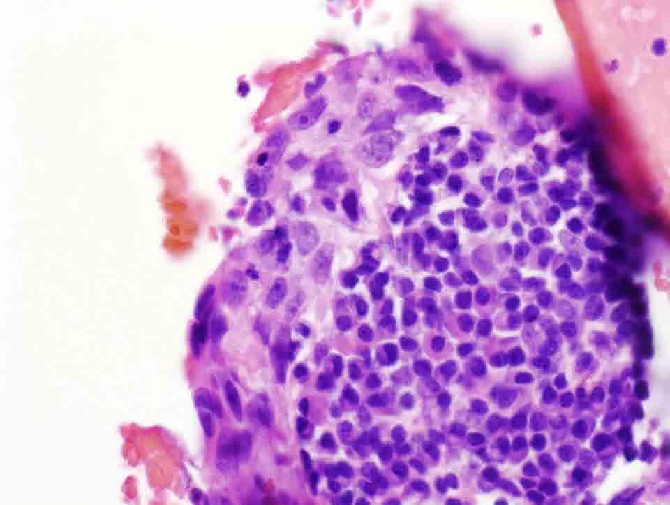 Lung, left middle lobe, CT-guided FNA: Cell Block, H & E stain, 40x Presentation