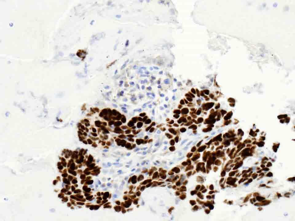 Lung, left middle lobe, cell block: p63 Immunostain, 20x Presentation material is