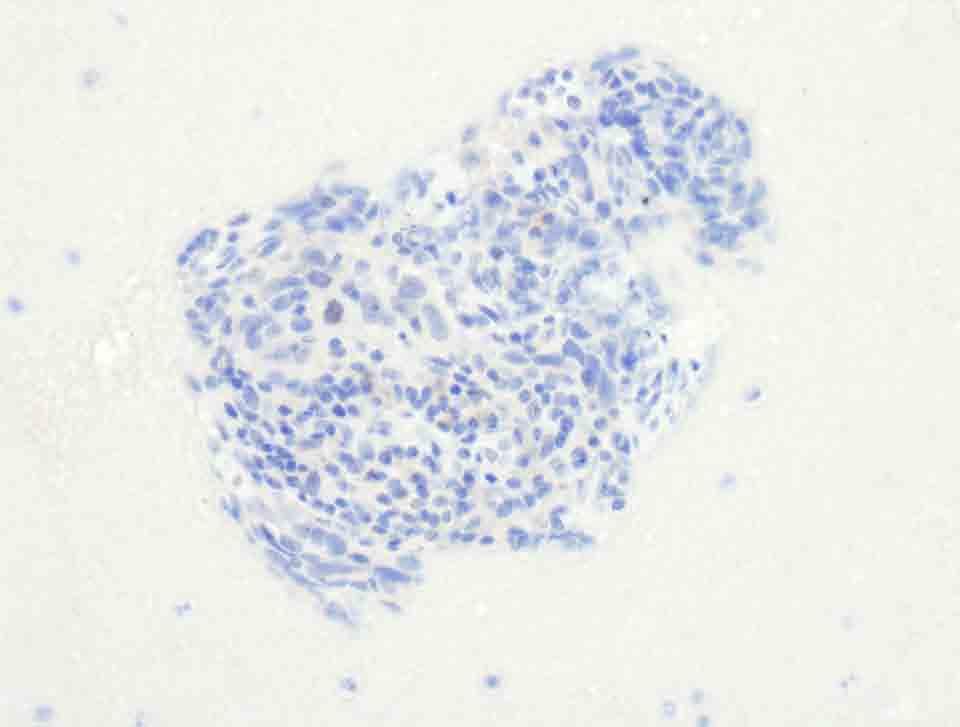 Lung, left middle lobe, cell block: TTF-1 Immunostain, 20x Presentation material is