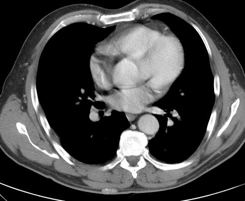 * Same CT slice. Does this narrow your differential diagnosis?