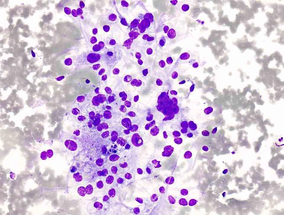 Bone, iliac, left, CT-guided FNA: Diff-Quik stain, 20x Presentation material is
