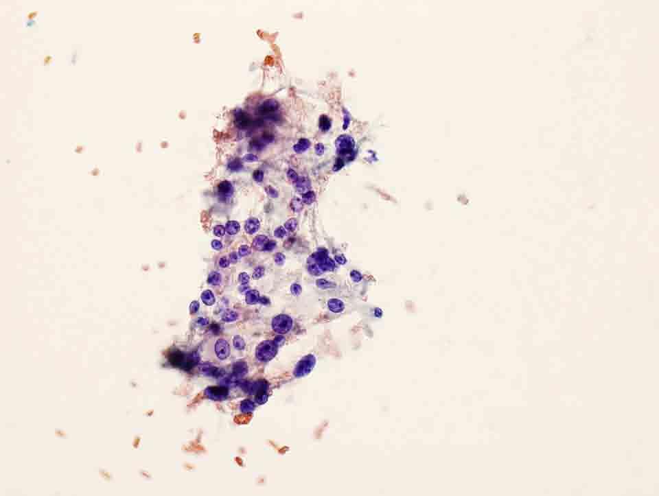 Bone, iliac, left, CT-guided FNA: Papanicolaou stain, 20x Presentation material is
