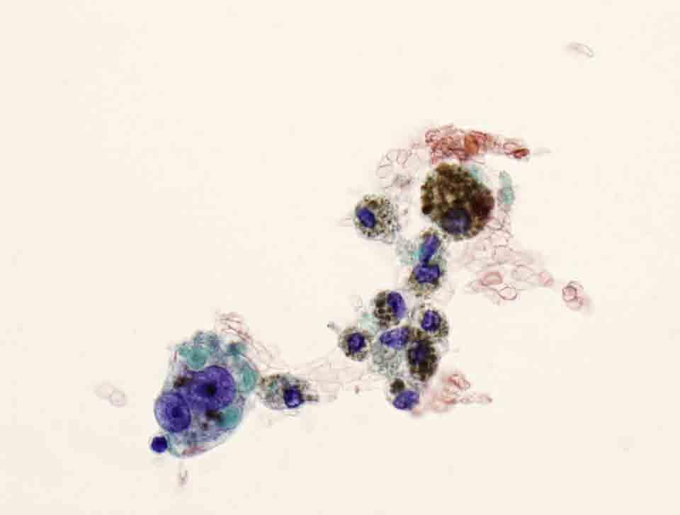 Bone, iliac, left, CT-guided FNA: Papanicolaou stain, 40x Presentation material is