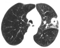 * 52-year-old female with bilateral pulmonary nodules with recent chest pain.