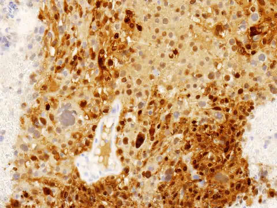 Bone, iliac, left, cell block: S-100 Immunostain, 20x Presentation material is