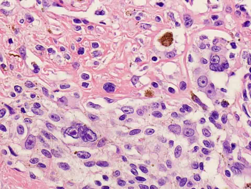 Skin, right neck, excision: H & E stain, 40x Presentation material is for