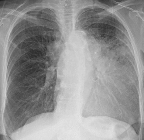 72-year-old with history of cough.