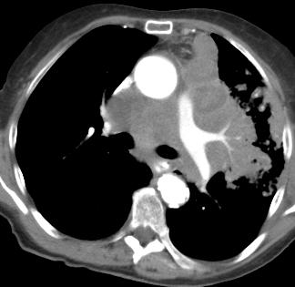 * Mass with associated consolidation of the left upper lobe with
