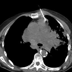 How can you minimize the risk of pneumothorax with biopsy? By going though the parasternal or transsternal region.