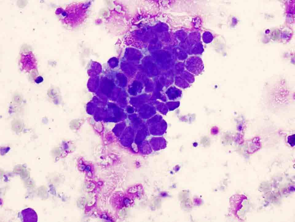 Lung, left, CT-guided FNA: Diff-Quik stain, 40x Presentation material is for