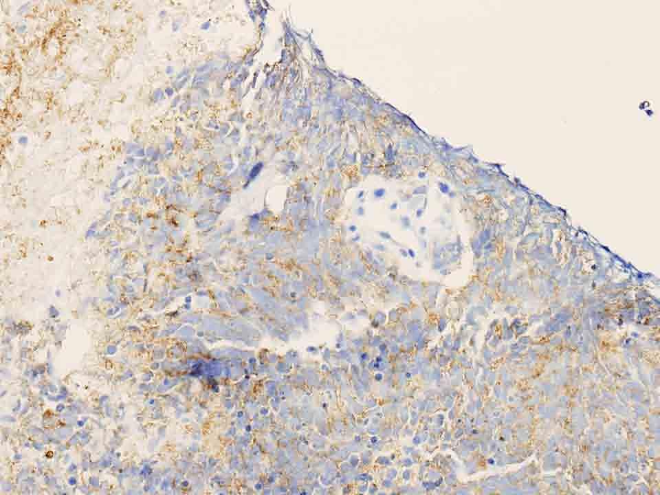 Lung, left anterior mediastinal mass, biopsy: CD 56 Immunostain, 20x Presentation