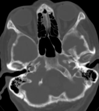 * 71-year-old female with right neck and occipital