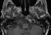 osteolytic lesion of right occipital condyle.