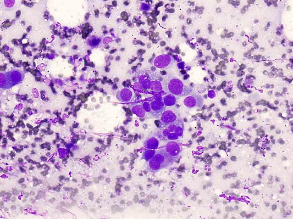 Bone, skull base, CT-guided FNA: Diff-Quik stain, 20x Presentation material is