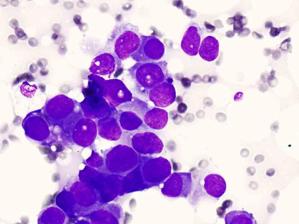 Bone, skull base, CT-guided FNA: Diff-Quik stain, 40x Presentation material is
