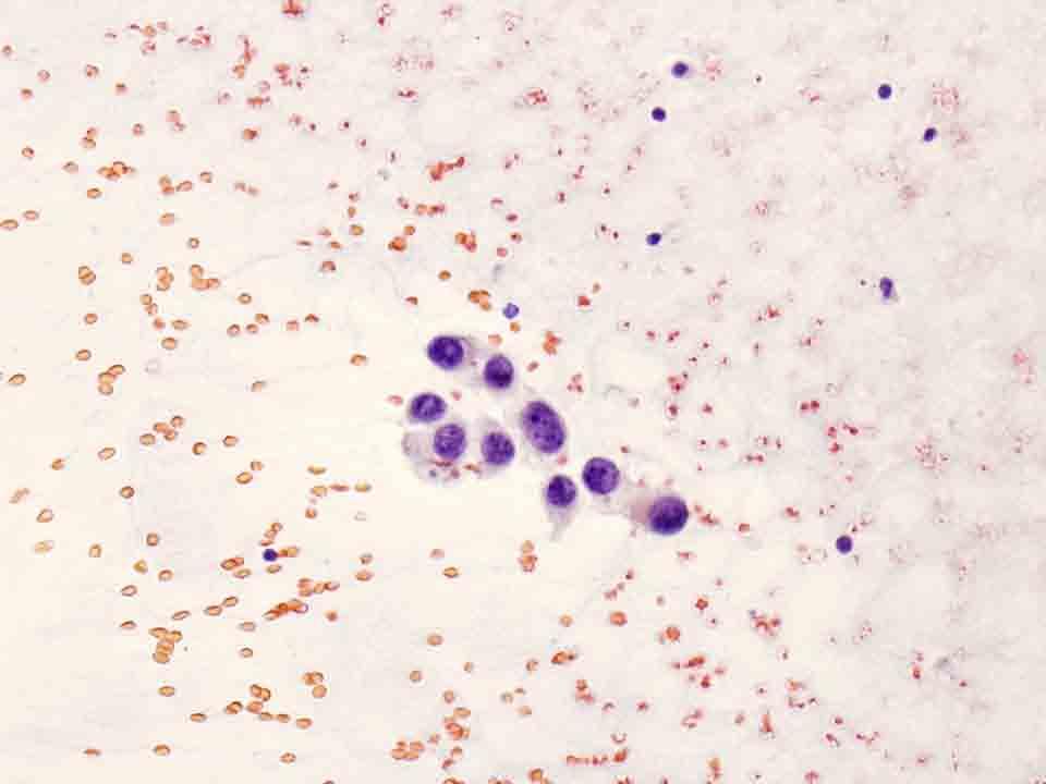 Bone, skull base, CT-guided FNA: Papanicolaou stain, 20x Presentation material is